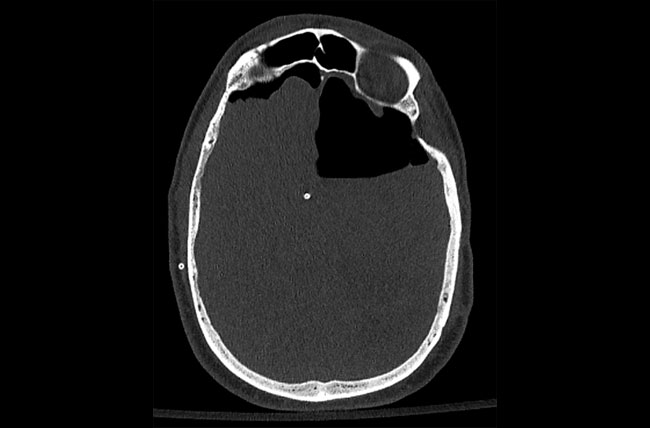 Axial CT scan demonstrating massive pneumocephalus